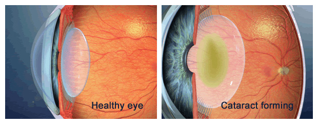 CATARACT CLEAR EYE & CLOUDY LENS